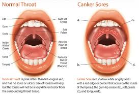 A canker sore looks like an ulcer or sore. Best Canker Sore Treatment In India Mouth Sore Cure Near Me