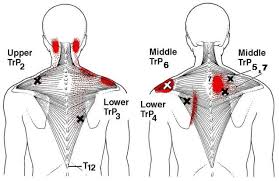 Trapezius Trigger Points And Referred Pain Pattern