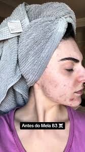 Resultados do Mela B3 da La Roche-Posay