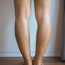 Image result for Genu Varum