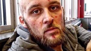 Zaczął ćpać w wieku 12 lat. Przez narkotyk zombie był na dnie. Tak wygląda  teraz