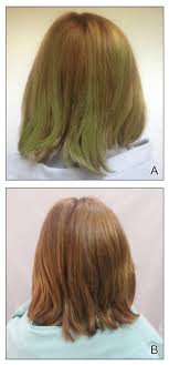 Here are several methods to remove the green from your hair and to counter the effects of the pool. Persistent Chlorotrichosis With Chronic Sun Exposure Mdedge Dermatology