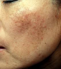 Melanin is the pigment that gives color to the skin and. The Vascular Characteristics Of Melasma Journal Of Dermatological Science