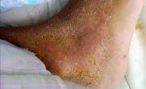 Image result for scabies norvegica