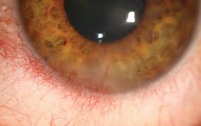 Nonnecrotizing, or disciform, keratitis and necrotizing keratitis. Breaching The Border