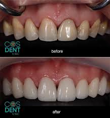Maybe you would like to learn more about one of these? What Is The Best Way To Whiten Your Teeth Quora
