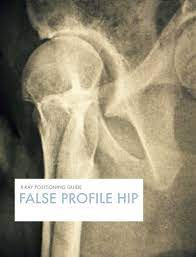 How To Position The False Profile View X Ray Of The Hip X Ray Profile View Ray