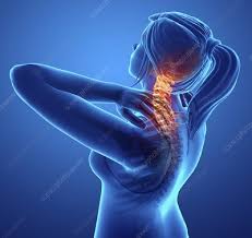 • amenorrhea / eating disorders common • femoral bmd. Female Back And Neck Anatomy Illustration Keyword Search Science Photo Library