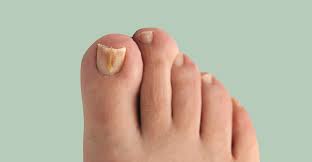 Athlete's foot this fungal infection generally starts between your toes. How To Treat Fungal Nail Effectively The Pharmaceutical Journal