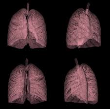 Learn about the symptoms and what to expect after diagnosis. Ct Screening Significantly Reduces Lung Cancer Mortality National Institutes Of Health Nih