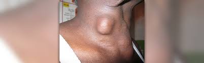 Ten symptoms of thyroid cancer 1. Signs And Symptoms Of Thyroid Cancer Cancer Articles Body Health Conditions Center Steadyhealth Com