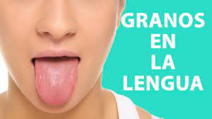 Como Curar Los Granos En La Lengua Youtube