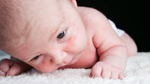 Bea mai multa apa, fa sport si foloseste un tricou din bumbac sa absoarba transpiratia(daca bubele le ai pe spate). Iritatia Din Cauza Caldurii La Bebelusi Cum O Poti Trata