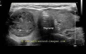 Ultrasound Image Gallery Thyroid Ultrasound Diagnostic Medical Sonography Thyroid