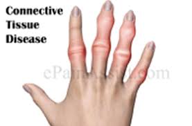 Image result for Connective Tissue Disorder