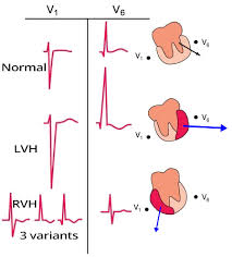 Image result for Left Ventricular Hypertrophy