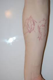 Tattoo removal lasers operate in a very narrow frequency and are very, very fast. My Experience With Surgical Excision And Laser Tattoo Removal Procedures Tatring