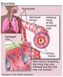 Batuk yang berpanjangan selama 2 minggu dan lebih. Blog Medical Articles 2012 Dr Indra K Muhtadi Dokter Plus