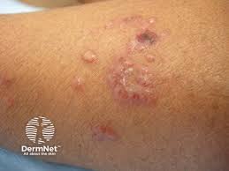Image result for Rhus Dermatitis