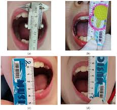 Image result for Trismus