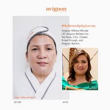 The merz aesthetics serendipity journey™ (masj) ค้นพบจุดเริ่มต้น. Avignon Journey Of Transformation Masj Luxy Beauty