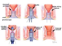 Image result for Rectal prolapse