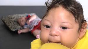 Image result wey dey for images of zika babies