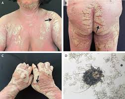 Image result for scabies norvegica