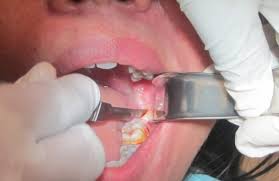 Check spelling or type a new query. Pemulihan Pasca Operasi Impaksi Gigi Bungsu Dokter Bedah Mulut Purwokerto Cilacap