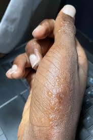 Image result for scabies human bites