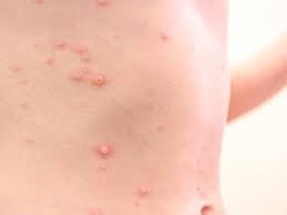 It is called monkeypox because it was first identified in laboratory monkeys. Monkeypox Virus Came Amid Covid 19 Who Said More Dangerous For Youth Know The Symptoms Causes And Prevention Jsnewstimes