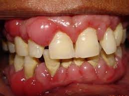 2 Home Remedies For Gum Swelling Swollen Gum Gum Treatment Gum Disease Remedies