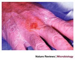 guideline finnish medical society duodecim. Tularaemia Bioterrorism Defence Renews Interest In Francisella Tularensis Nature Reviews Microbiology