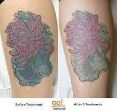 Not Happy With How This Cover Up Was Looking The Client Decided To Start The Removal Process Cover Ups Are Typical In 2020 Laser Tattoo Removal Tattoos Tattoo Removal