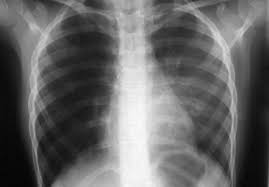 »» la bronchiolite oblitérante (bo) constitue la complication à long terme la plus fréquente après une transplantation pulmonaire, à l'origine d'une lourde morbimortalité. Bronchiolite Obliterante Postinfectieuse Sciencedirect