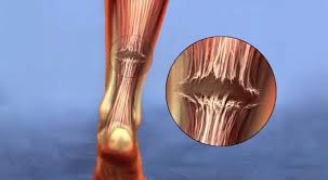 Achilles tendon , also called calcaneal tendon , strong tendon at the back of the heel that connects the calf muscles to the heel. Achilles Tendon Tear Symptoms And Treatment Orthoinfo Aaos