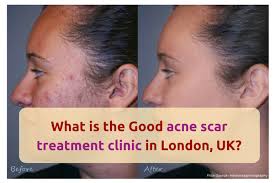 Laser hair removal provides fast removal of unwanted hair from large areas of the face and body with few side effects. What Is The Good Acne Scar Treatment Clinic In London Uk Quora