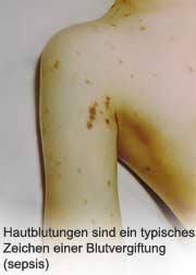 Möglich sind auch stecknadelkopfgroße, weiße flecken auf den unterarmen, die keine weiteren beschwerden auslösen. Meningitis Teil V Was Darf Es Kosten Ein Leben Zu Retten Gesundheit Aktuell De