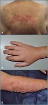 Image result for dermatitis contacta toxica