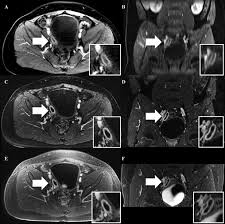 Conical Ultrashort Echo Time Ute Mri In The Evaluation Of