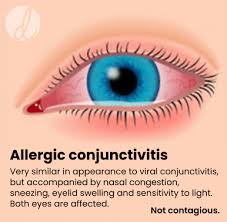 Image result for Allergic Conjunctivitis