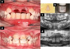 Image result for Tooth Avulsion