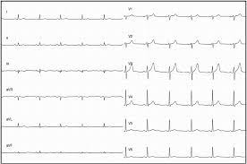 Myocarditides) is a general term referring to inflammation of the myocardium. Miocarditis Extensa Sociedad Espanola De Cardiologia