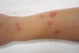 Image result for scabies human bites