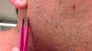 A close and improperly executed shave sets the stage for many ingrown beard hairs to develop. The Longest Grossest Ingrown Hair In History Youtube