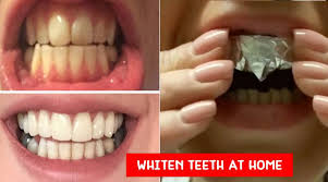 With teeth whitening products costing over $40 a pop, it's no surprise that we've received many questions from readers asking how to make homemade whitening toothpaste. Does Hydrogen Peroxide Whiten Teeth Instantly Teethwalls