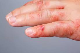 Image result for scabies human bites