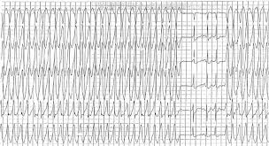 We did not find results for: Atrial Fibrillation