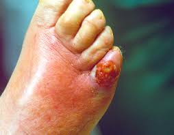 Cellulitis in Southfield | Cellulitis 48034 | Southfield Cellulitis