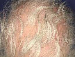 Hair grows at the rate of 1/2 inch per month. Psychological Effects Of Hair Loss Dermnet Nz